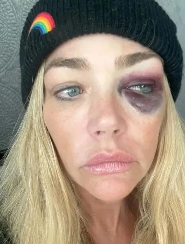 Дениз Ричардс избили, фото с синяками