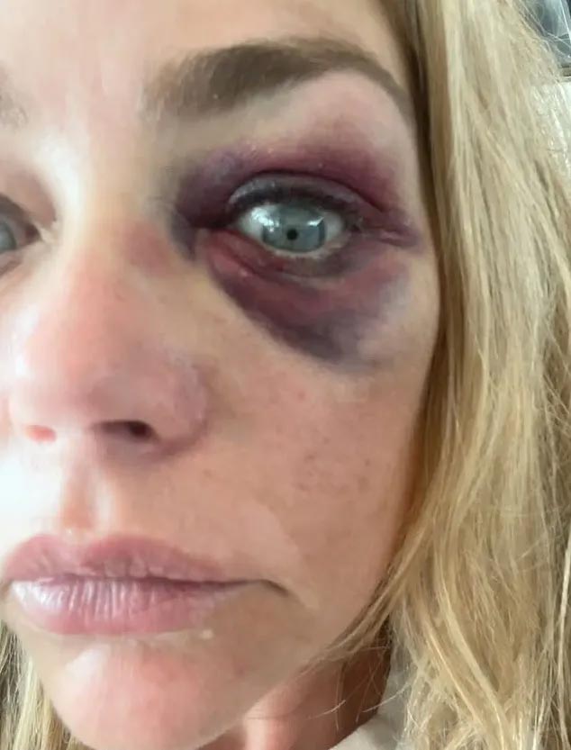 Дениз Ричардс избили, фото с синяками